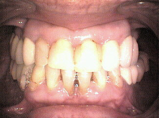 Carillas