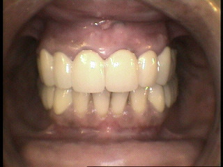 Carillas